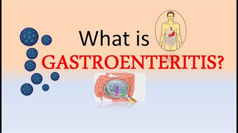 1 Acute gastroenteropathy due to Norovirus Your stomach or your intestines have been attacked by pathogens, causing inflammation. . Gastroenteritis icd 10